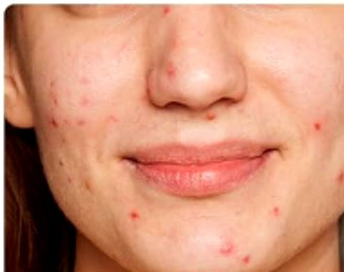 Post-acne marks before