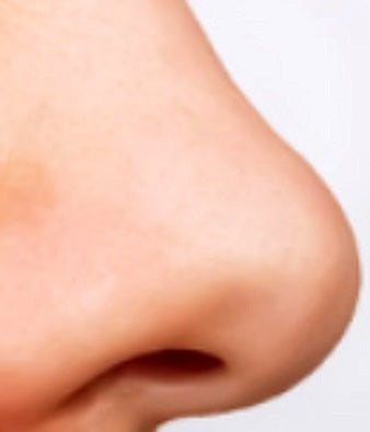 Blackheads after