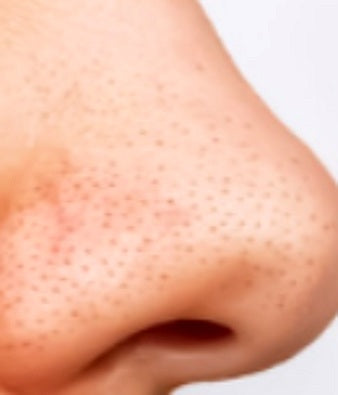 Blackheads before